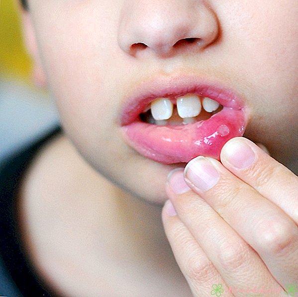 Causas de úlceras na boca em crianças