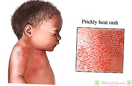 幼児の発疹 - それは深刻ですか？