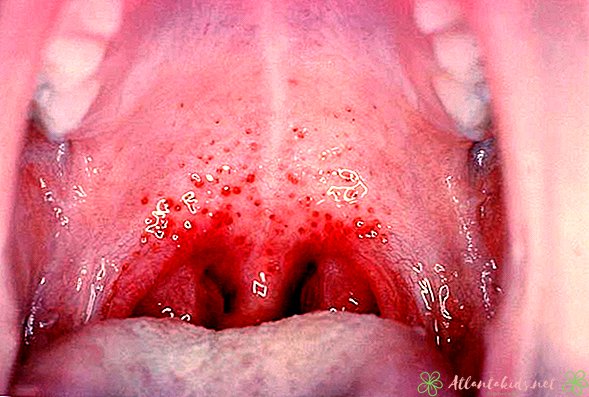 Môže dieťa dostať Strep throat? - Nové detské centrum