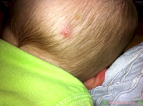 Pimple på Baby Head - New Kids Center