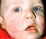 Virale huiduitslag bij kinderen: oorzaken, symptomen & behandelingen - New Kids Centre