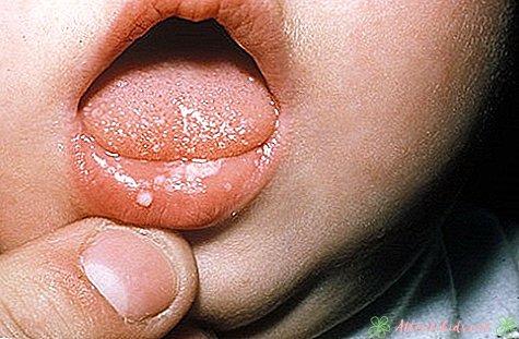 Bērnu rauga infekcija - jauns bērnu centrs