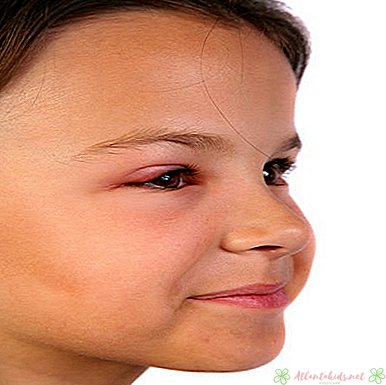 Silmien tartunnan tyypit, oireet ja hoidot vauvoilla - uusi lasten keskus