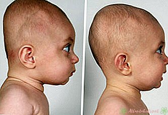 Flat Head Syndrome - Nové dětské centrum