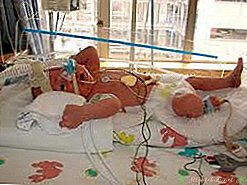 Frühgeborenes Baby, geboren in der 34. Schwangerschaftswoche - Neues Kinderzentrum