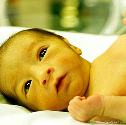 Cómo distinguir la ictericia en los recién nacidos