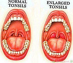 Quelles sont les causes de l'élargissement des amygdales chez les enfants?