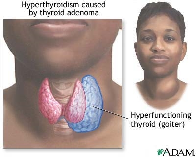 Hipotiroidi Gebeliği Nasıl Etkiler?