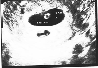 Jsem těhotná s dvojčaty? - Nové dětské centrum