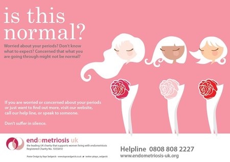 Vad ska du veta om endometrios?