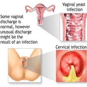Quels sont les symptômes de gonflement vaginal pendant la grossesse?