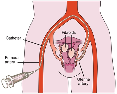 Wat zijn de symptomen van vaginale zwelling tijdens de zwangerschap?
