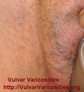 O que causa inchaço vaginal após o intercurso?