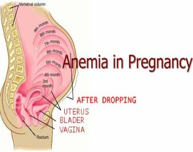 Nėštumo anemijos tipai ir priežastys
