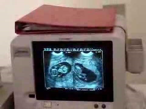 Muco cervicale durante la gravidanza - New Kids Center