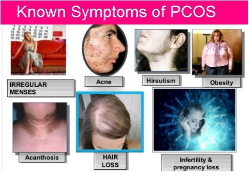 Каковы симптомы PCOS?