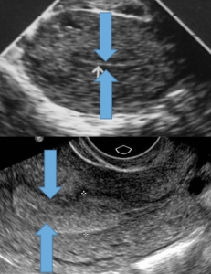 Mikä on transvaginaalinen ultraääni?