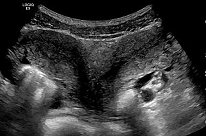 Kas ir transvaginālā ultraskaņa?
