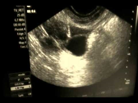 O que é um ultrassom transvaginal?
