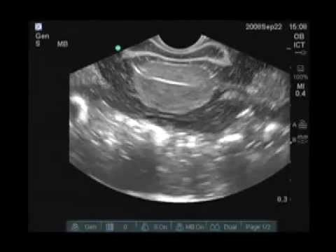 Čo je transvaginálny ultrazvuk?