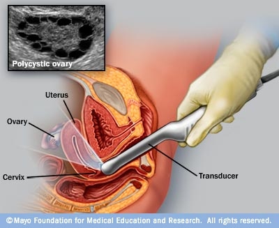 Vad är en transvaginal ultraljud?