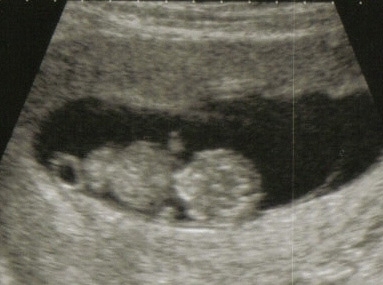 Ultrazvuk datování těhotenství prvního trimestru