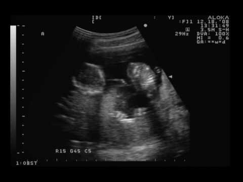 ¿Cuándo se realiza el primer ultrasonido durante el embarazo? - New Kids Center