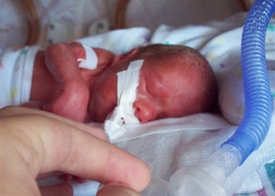 Wat zijn mogelijke gezondheidsproblemen voor premature baby's?