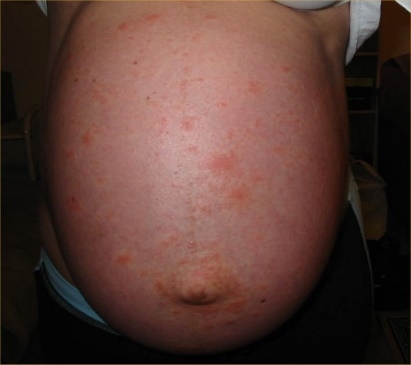 Normale bloeddruk tijdens de zwangerschap - New Kids Center