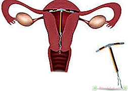 Copper IUD Side Effects - New Kids Center