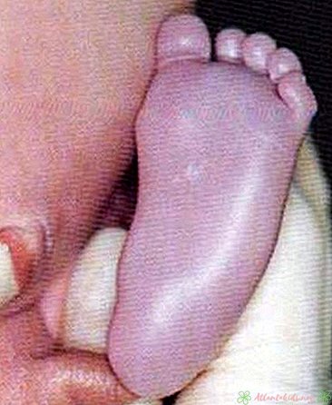 बेबी त्वचा मलिनकिरण के 7 कारण और मदद करने के तरीके - नए बच्चे केंद्र