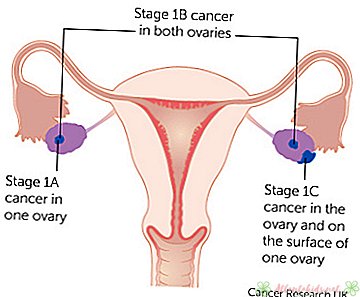 Estadificación del cáncer de ovario - New Kids Center