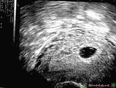 Co můžete očekávat s ultrazvukem během 5týdenního těhotenství - Nové dětské centrum