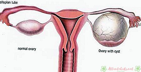 Chist ovarian când este gravidă: semne și tratamente - noul centru pentru copii