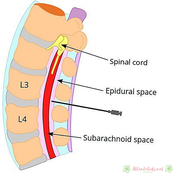 Rozdiel medzi epidurálnym a spinálnym blokom - nové detské centrum