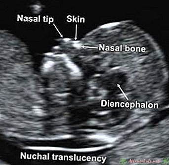 Pemutaran Translucency Nuchal - Pusat Anak Baru