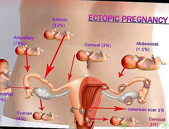 Negimdinio nėštumo simptomai