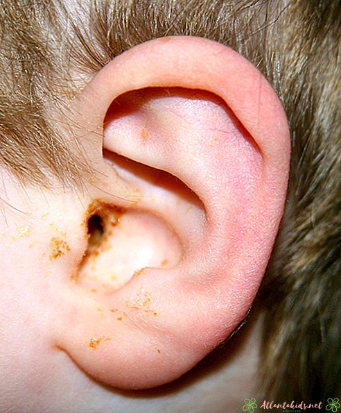 Známky infekcie uší u batole - nové detské centrum