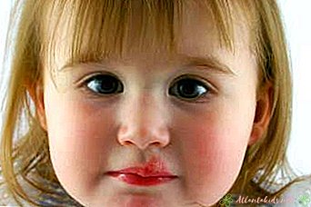 Herpes labial en niños pequeños - New Kids Center