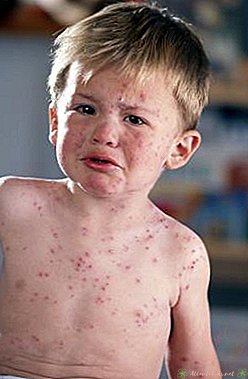 Fever and Rash in Toddlers - New Kids Center